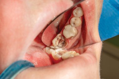 bir insan molar dişi kırık bir kırık Close-up. Konsantrasyon