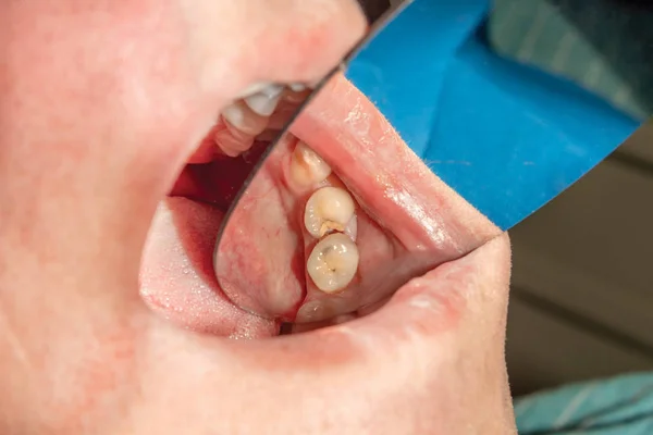 Restauração Molar Dente Humano Com Material Enchimento Conceito Odontologia Estética — Fotografia de Stock