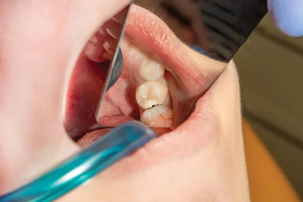 Obnova Moláru Lidský Zub Zásypového Materiálu Koncept Estetické Záchovná Stomatologie — Stock fotografie