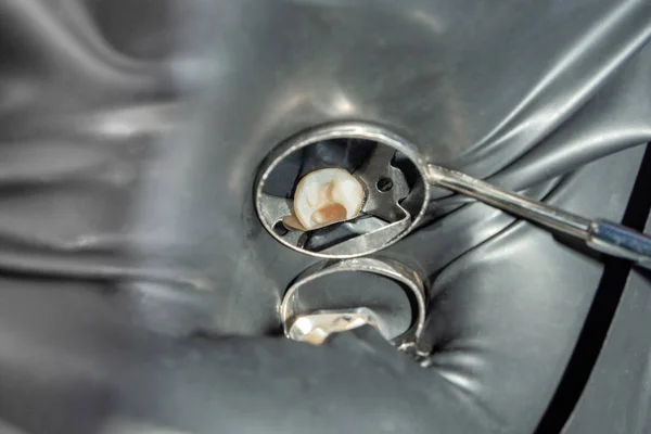 充填材とヒトの歯の奥歯の修復 歯科医院で審美的な修復歯科のコンセプト — ストック写真