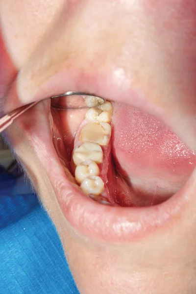 Dentes Doentes Humanos Close Cáries Fraturado Conceito Raiz Dente Tratamento — Fotografia de Stock