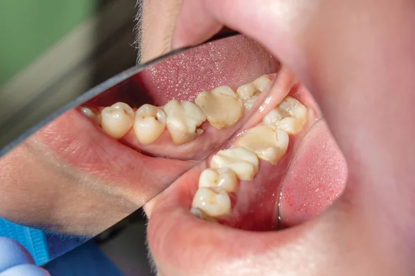 Dents Malades Humaines Gros Plan Caries Concept Racine Dent Fracturée — Photo