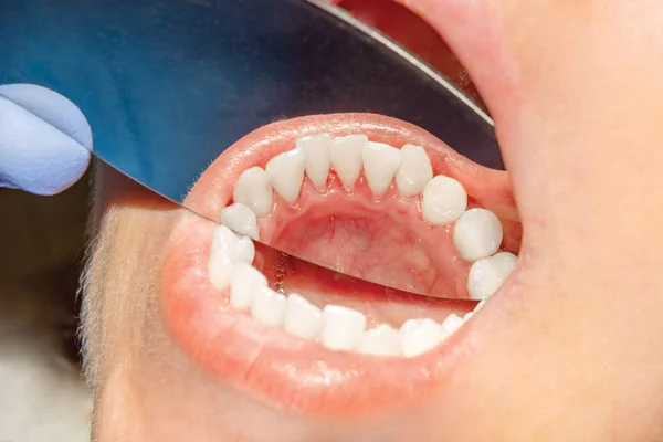 Placa Paciente Pedra Tratamento Odontológico Traqueia Dentária — Fotografia de Stock