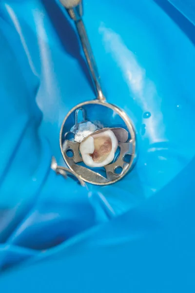 ヒトの歯治療と修復中のクローズ アップ — ストック写真