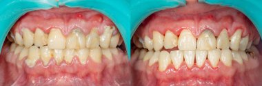 Hastanın, taş plak. Dental plak, profesyonel ağız hijyeni diş hekimliği tedavi. Sigara ve diş temizliği zarar kavramı