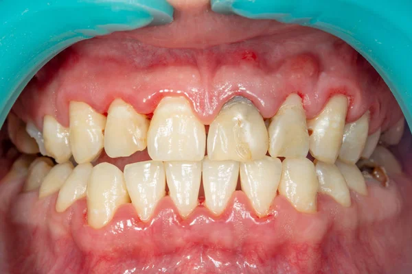 Доска Пациента Камень Стоматологическое Лечение Зубной Бляшки Профессиональная Гигиена Полости — стоковое фото