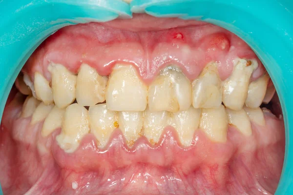 患者の石のプラーク 専門的口腔衛生の歯科治療 喫煙と歯の清掃に害の概念 — ストック写真