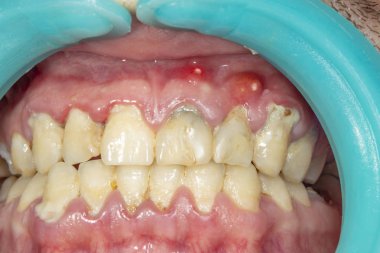 İnsan dişleri closeup dental plak ve gingivitis iltihabı. Diş ve kötü hijyen fırçalama kavramı