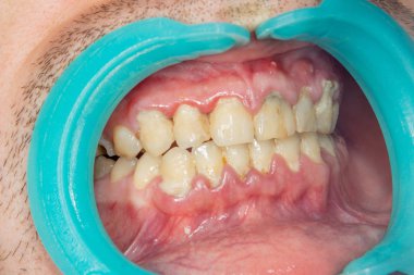 İnsan dişleri closeup dental plak ve gingivitis iltihabı. Diş ve kötü hijyen fırçalama kavramı