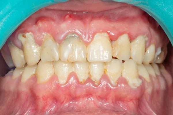 人の歯を削除し 歯科医院でプラークを洗浄後のクローズ アップ 健康的な笑顔のコンセプト — ストック写真