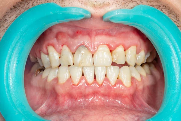 Close Dos Dentes Uma Pessoa Depois Remover Limpar Uma Placa — Fotografia de Stock