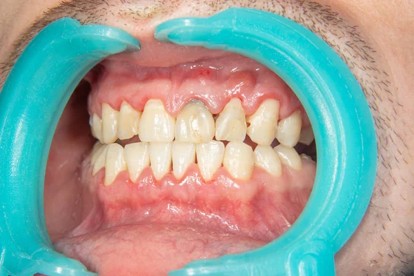 Menselijke Tanden Close Met Tandplak Ontsteking Van Gingivitis Concept Van — Stockfoto