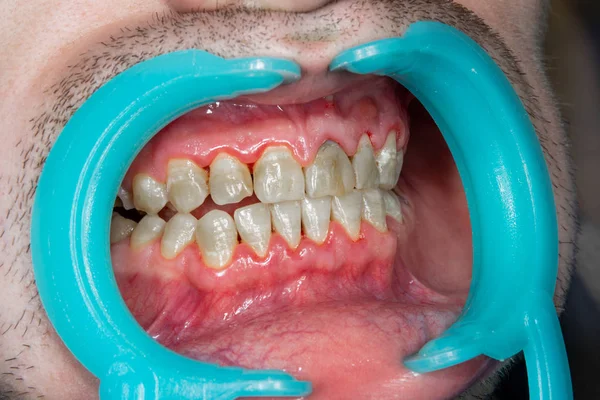 Denti Umani Primo Piano Con Placca Dentale Infiammazione Della Gengivite — Foto Stock