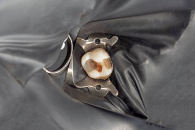 Diş bakımı. Haham kullanarak diş kompozit fotopolimer materyaliyle dolduruluyor. Diş sağlığı kliniğinde diş tedavisi kavramı