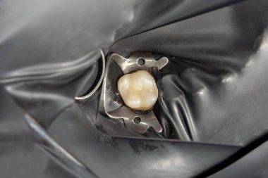 iki çürük tedaviden sonra üst çene yan dişlerin çiğneme. Dolgu lastik baraj sistemiyle Fotopolimer çiğneme yüzeyle restorasyonu