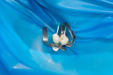 Fotoğraf endodontik tedavi alt azı kalıcı diş Endodontik dosyasıyla molar diş kanallar ile apex arama, diş cofferdam tarafından bağlı kelepçe ile