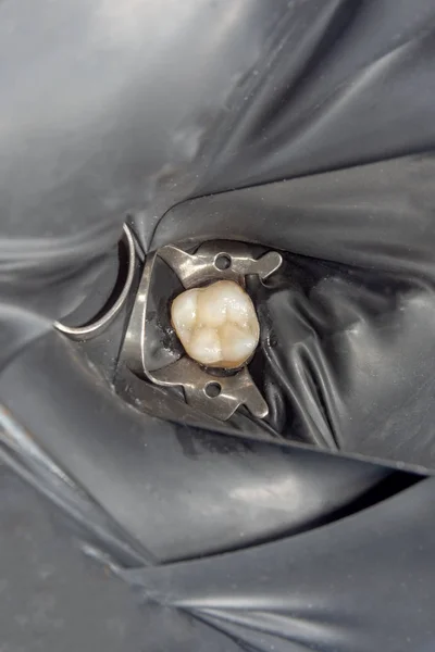 歯のケアだ ラバーを使用して歯科複合光高分子材料で充填します 歯科診療所における歯科治療の概念 — ストック写真