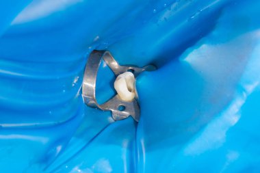 Fotoğraf endodontik tedavi alt azı kalıcı diş Endodontik dosyasıyla molar diş kanallar ile apex arama, diş cofferdam tarafından bağlı kelepçe ile