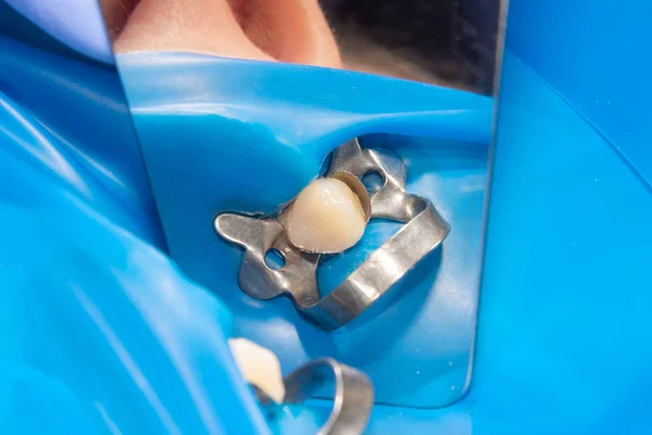 Dois Dentes Laterais Mastigatórios Mandíbula Superior Após Tratamento Cárie Restauração — Fotografia de Stock