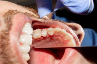 bir insan çürük carious diş tedavi aşamasında bir diş kliniğinde yakın çekim. Kauçuk baraj sistemiyle lateks eşarp ve metal klipleri, photopolymeric kompozit dolgular üretiminde kullanımı