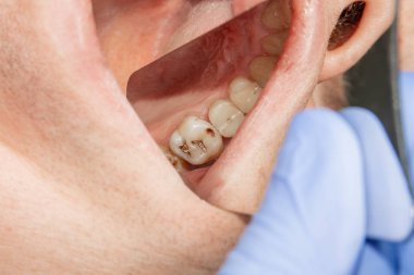bir insan çürük carious diş tedavi aşamasında bir diş kliniğinde yakın çekim. Kauçuk baraj sistemiyle lateks eşarp ve metal klipleri, photopolymeric kompozit dolgular üretiminde kullanımı