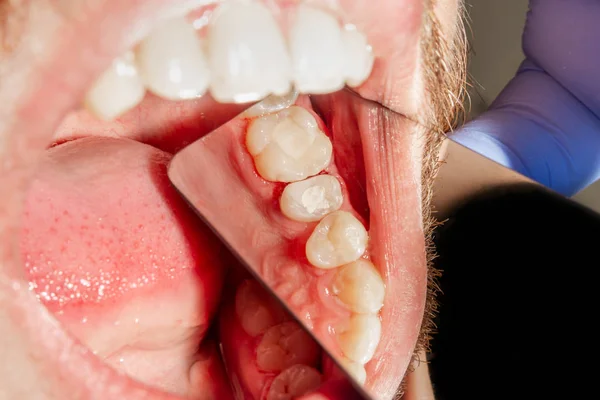 Tratamento Endodôntico Dos Dentes Close Limpeza Das Raízes Dos Dentes — Fotografia de Stock