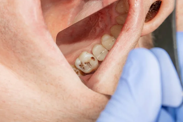 Close Dente Cariado Podre Humano Fase Tratamento Uma Clínica Odontológica — Fotografia de Stock