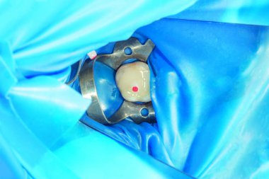 Diş bakımı. Haham kullanarak diş kompozit fotopolimer materyaliyle dolduruluyor. Diş sağlığı kliniğinde diş tedavisi kavramı