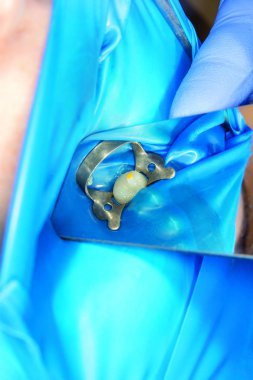 Diş bakımı. Haham kullanarak diş kompozit fotopolimer materyaliyle dolduruluyor. Diş sağlığı kliniğinde diş tedavisi kavramı