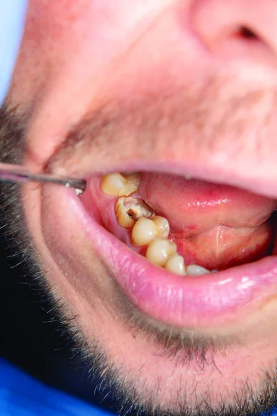 Dois Dentes Laterais Mastigatórios Mandíbula Superior Após Tratamento Cárie Restauração — Fotografia de Stock