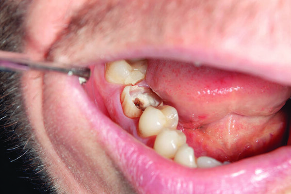 Dental caries. Filling with dental composite photopolymer material using rabbders. The concept of dental treatment in a dental clinic