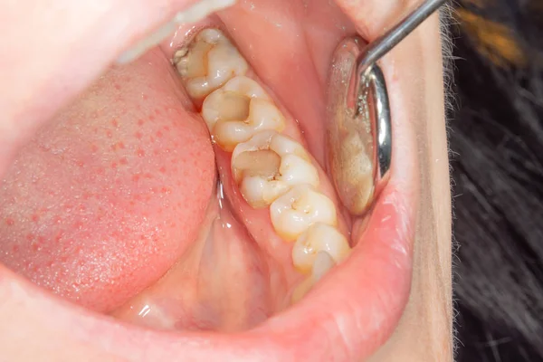 Des Caries Dentaires Remplissage Avec Matériau Photopolymère Composite Dentaire Aide — Photo