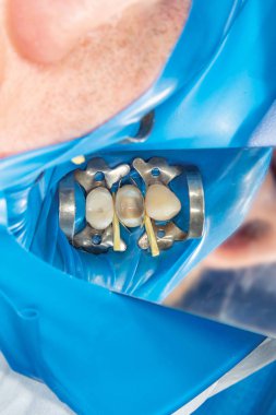 Diş bakımı. Haham kullanarak diş kompozit fotopolimer materyaliyle dolduruluyor. Diş sağlığı kliniğinde diş tedavisi kavramı