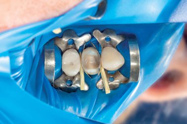 iki çürük tedaviden sonra üst çene yan dişlerin çiğneme. Dolgu lastik baraj sistemiyle Fotopolimer çiğneme yüzeyle restorasyonu