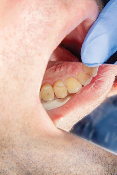 Diş Bakımı Haham Kullanarak Diş Kompozit Fotopolimer Materyaliyle Dolduruluyor Diş — Stok fotoğraf