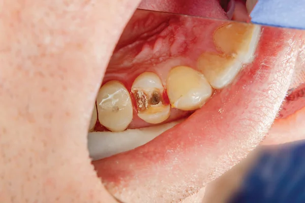 Dois Dentes Laterais Mastigatórios Mandíbula Superior Após Tratamento Cárie Restauração — Fotografia de Stock