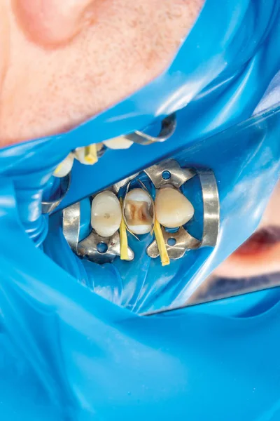 Diş bakımı. Haham kullanarak diş kompozit fotopolimer materyaliyle dolduruluyor. Diş sağlığı kliniğinde diş tedavisi kavramı