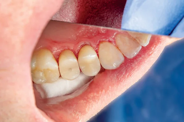 Δύο Μάσημα Πλευρά Δόντια Της Άνω Γνάθου Μετά Από Θεραπεία — Φωτογραφία Αρχείου