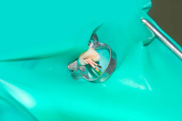 牙齿根部的治疗 封闭和清洁一个龋齿的人牙特写的宏 现代牙髓治疗中的创新与技术理念 — 图库照片