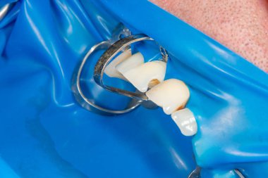 Diş bakımı. Haham kullanarak diş kompozit fotopolimer materyaliyle dolduruluyor. Diş sağlığı kliniğinde diş tedavisi kavramı