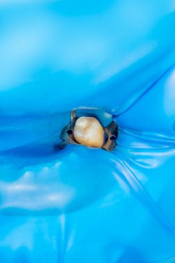 Diş tedavisi diş kliniği. Carious çürük diş yakın çekim makro. Endodontik kanallar tedavisinde