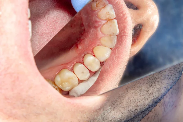 Dental treatment in the dental clinic. Rotten carious tooth close-up macro. Treatment of endodontic canals