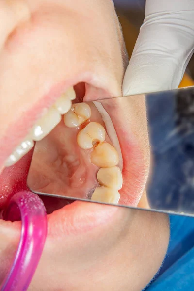 Οδοντιατρική Θεραπεία Στο Οδοντιατρείο Σάπιο Δόντι Σάπιος Κοντινής Θεραπεία Της — Φωτογραφία Αρχείου