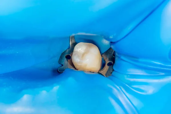 牙齿蛀牙 用狂犬病菌填充牙科合成光聚合物材料 牙科诊所的牙科治疗概念 — 图库照片