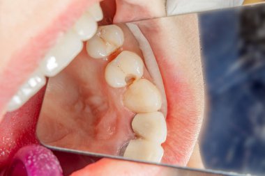 Diş bakımı. Haham kullanarak diş kompozit fotopolimer materyaliyle dolduruluyor. Diş sağlığı kliniğinde diş tedavisi kavramı