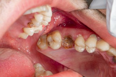 Diş bakımı. Haham kullanarak diş kompozit fotopolimer materyaliyle dolduruluyor. Diş sağlığı kliniğinde diş tedavisi kavramı