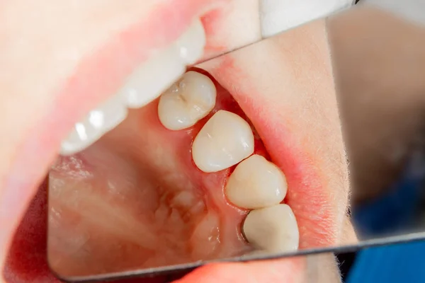 Cárie Dentária Enchimento Com Material Fotopolímero Composto Dental Usando Coelhos — Fotografia de Stock