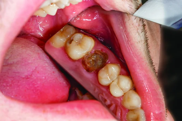 two chewing side teeth of the upper jaw after treatment of caries. Restoration of the chewing surface with a photopolymer filling material using the Rubber Dam system