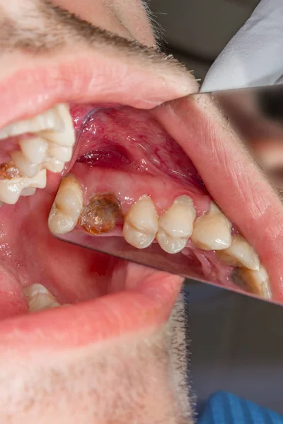 Cárie Dentária Enchimento Com Material Fotopolímero Composto Dental Usando Coelhos — Fotografia de Stock