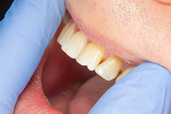 Cárie Dentária Enchimento Com Material Fotopolímero Composto Dental Usando Coelhos — Fotografia de Stock